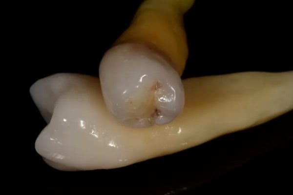 1-Carlos Ry 01 dientes de lujo alta definición realistica caracterización a medida