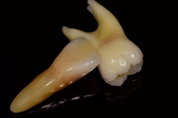 3-Carlos Ry 01 dientes de lujo alta definición realistica caracterización a medida